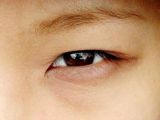 Asian woman with a single eyelid and moderate epicanthal fold; double eyelid surgery, DST,